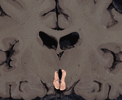 a coronal view of the hypothalamus