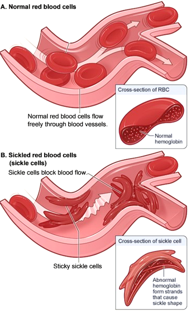 The Genetics Of Sickle Cell Anemia And Sickle Cell Trait How One Gene Affects Multiple 